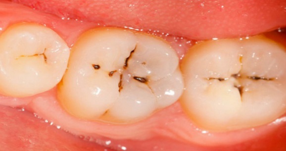 Astuces anti-cavités dent